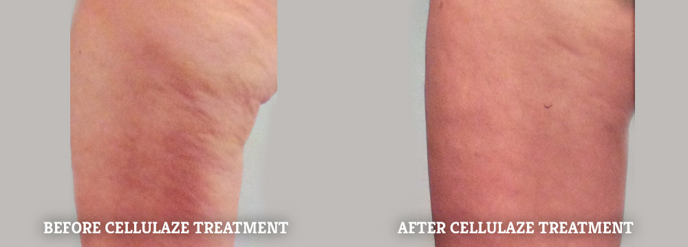 Cellulite Treatment Specialist · 2021 Top Laser Dermatologist NYC